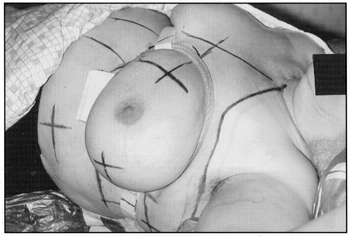 photo of Bravelle Breast Ring Placed on Breast