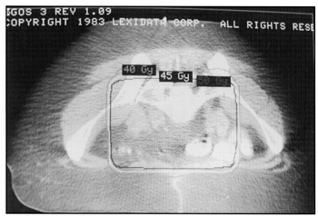 photo of CT with isodose curve of Small Bowel in Belly Board