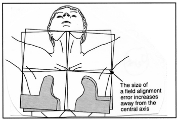 drawing chest treatment field alignment and misalignment