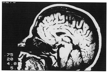 photo saggital MRI head scan