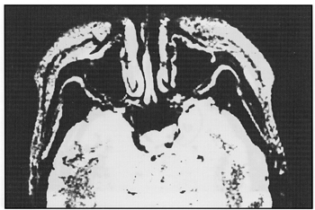 photo head scan transverse MRI