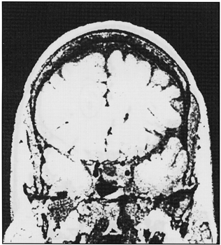 photo coronal MRO scan head